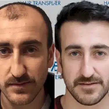 Пересадка волос