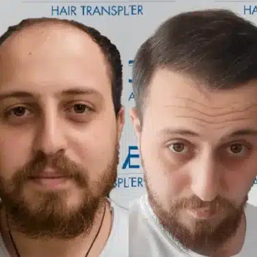 Пересадка волос