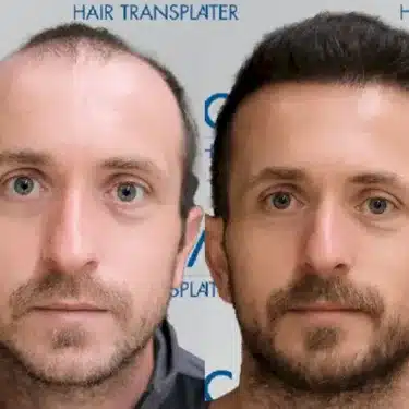 Пересадка волос