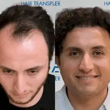 Пересадка волос