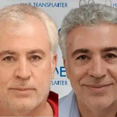 Пересадка волос