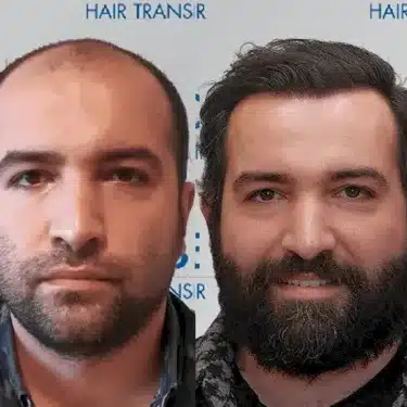 Пересадка волос