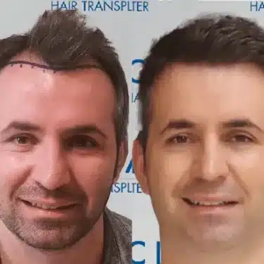 Пересадка волос