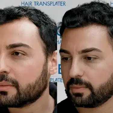 Пересадка волос