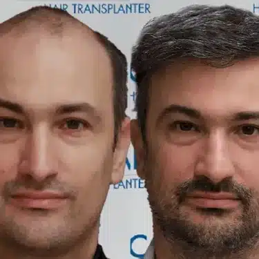 Пересадка волос