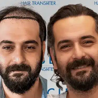 Пересадка волос