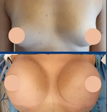 Пластика груди