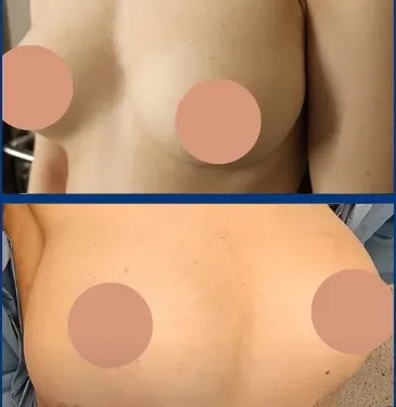 Пластика груди