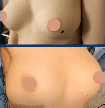 Пластика груди