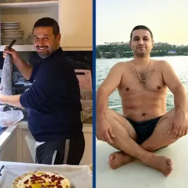 Хирургия похудения