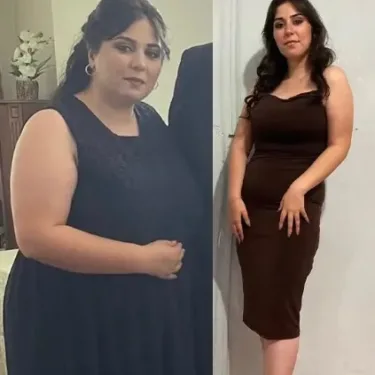 Хирургия похудения