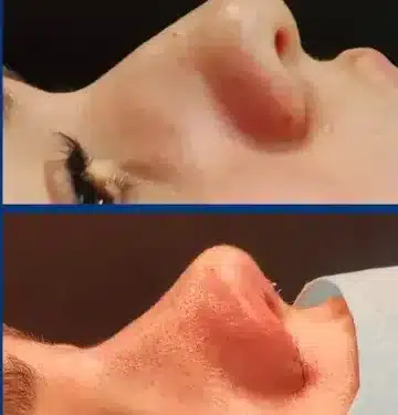 Ринопластика