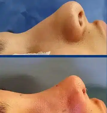 Ринопластика