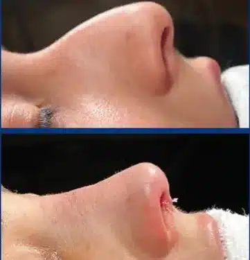 Ринопластика