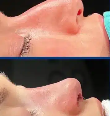 Ринопластика