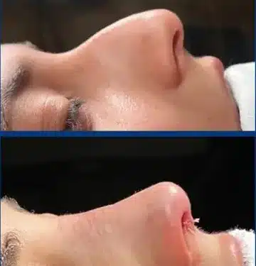 Ринопластика