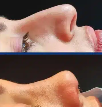 Ринопластика