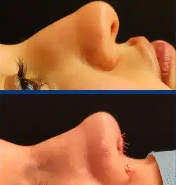 Ринопластика