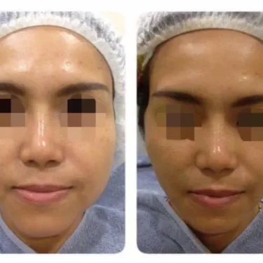 Anti-aging, dermato-cosmetic procedures