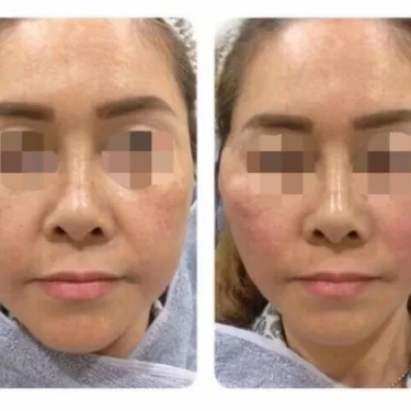 Anti-aging, dermato-cosmetic procedures