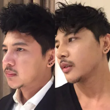 Anti-aging, dermato-cosmetic procedures