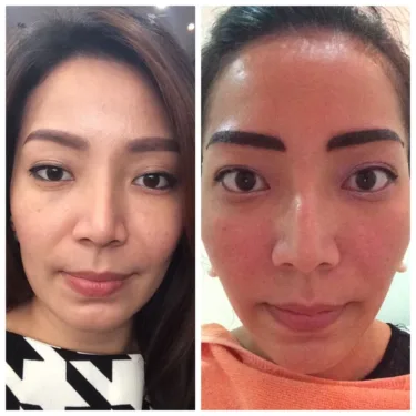 Anti-aging, dermato-cosmetic procedures