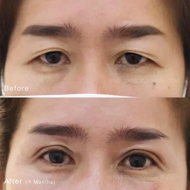 Пластика верхних век