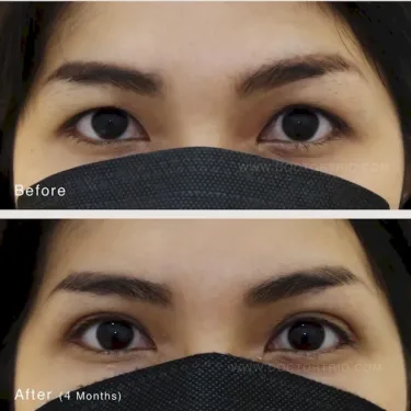 Пластика верхних век