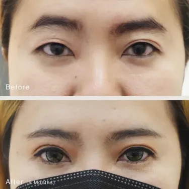 Пластика верхних век