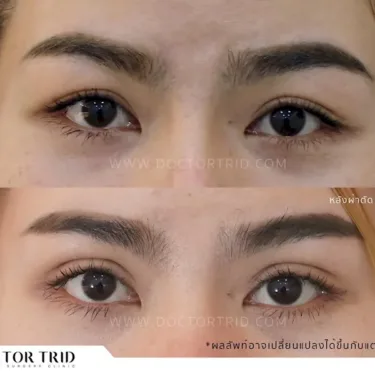 Пластика верхних век