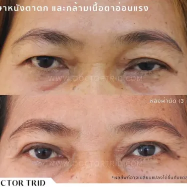 Пластика верхних век