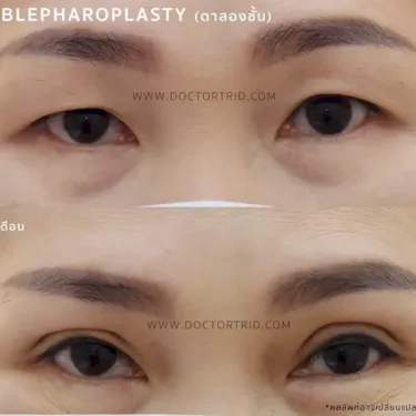 Пластика верхних век