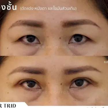 Пластика верхних век