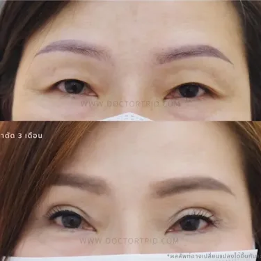 Пластика верхних век