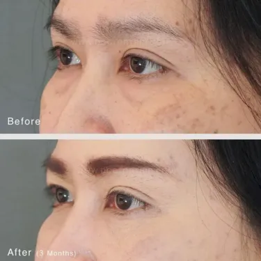 Пластика нижних век