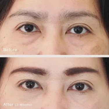 Пластика нижних век