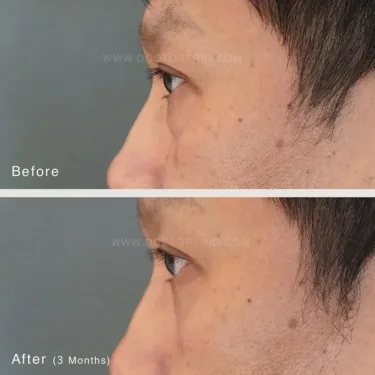 Пластика нижних век