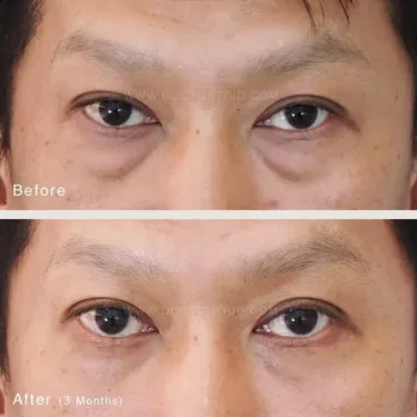 Пластика нижних век