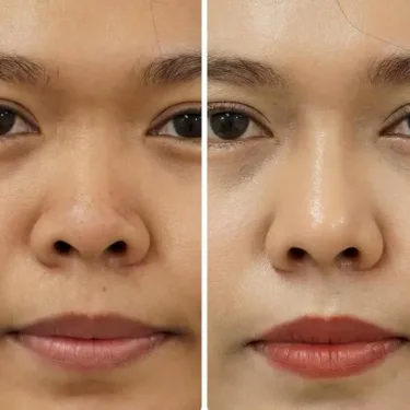 Пластика носа