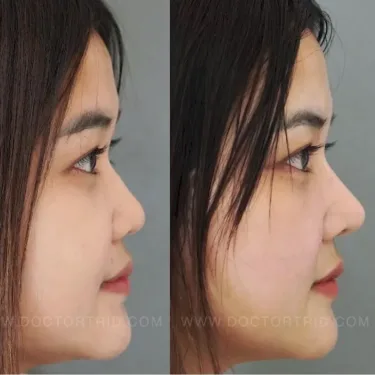 Пластика носа