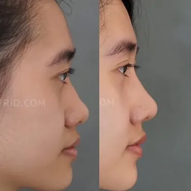 Пластика носа