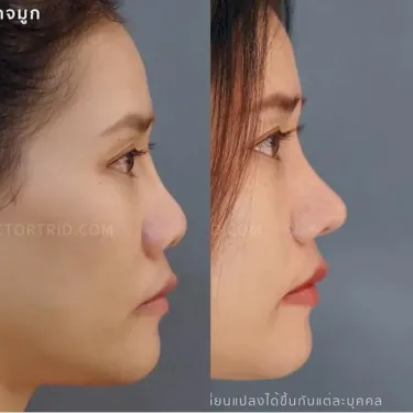 Пластика носа