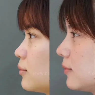 Пластика носа