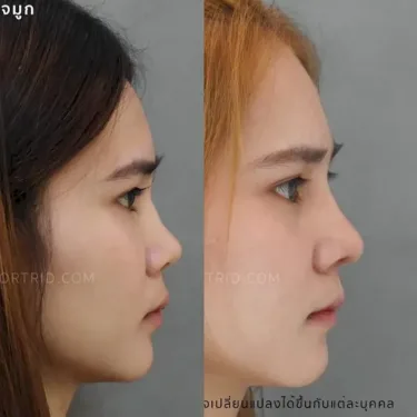 Пластика носа