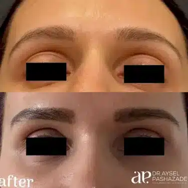 Подтяжка бровей