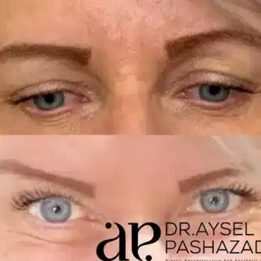 Подтяжка бровей (лисий взгляд)