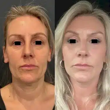 Глубокая подтяжка лица