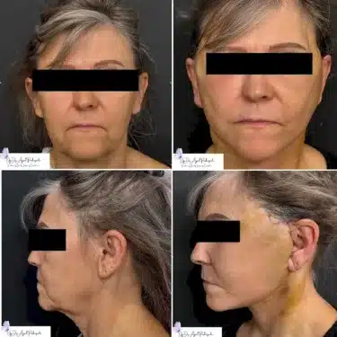 Глубокая подтяжка лица