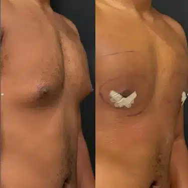 Коррекция гинекомастии