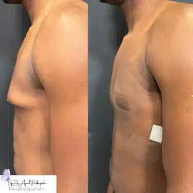 Коррекция гинекомастии